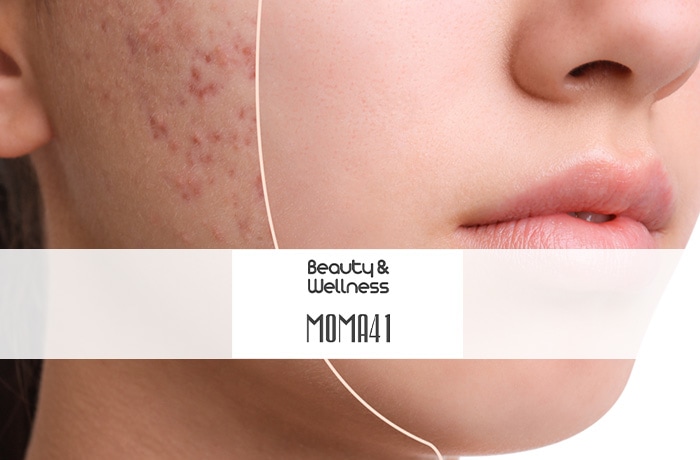 trattamento viso contro l'acne